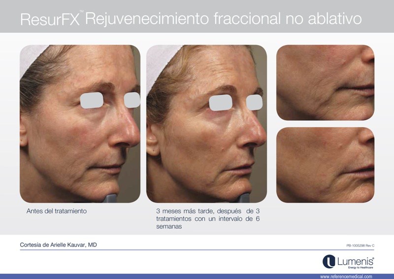 CLÍNICA DOCTORA PAEZ | EL ÁCIDO TRANEXÁMICO